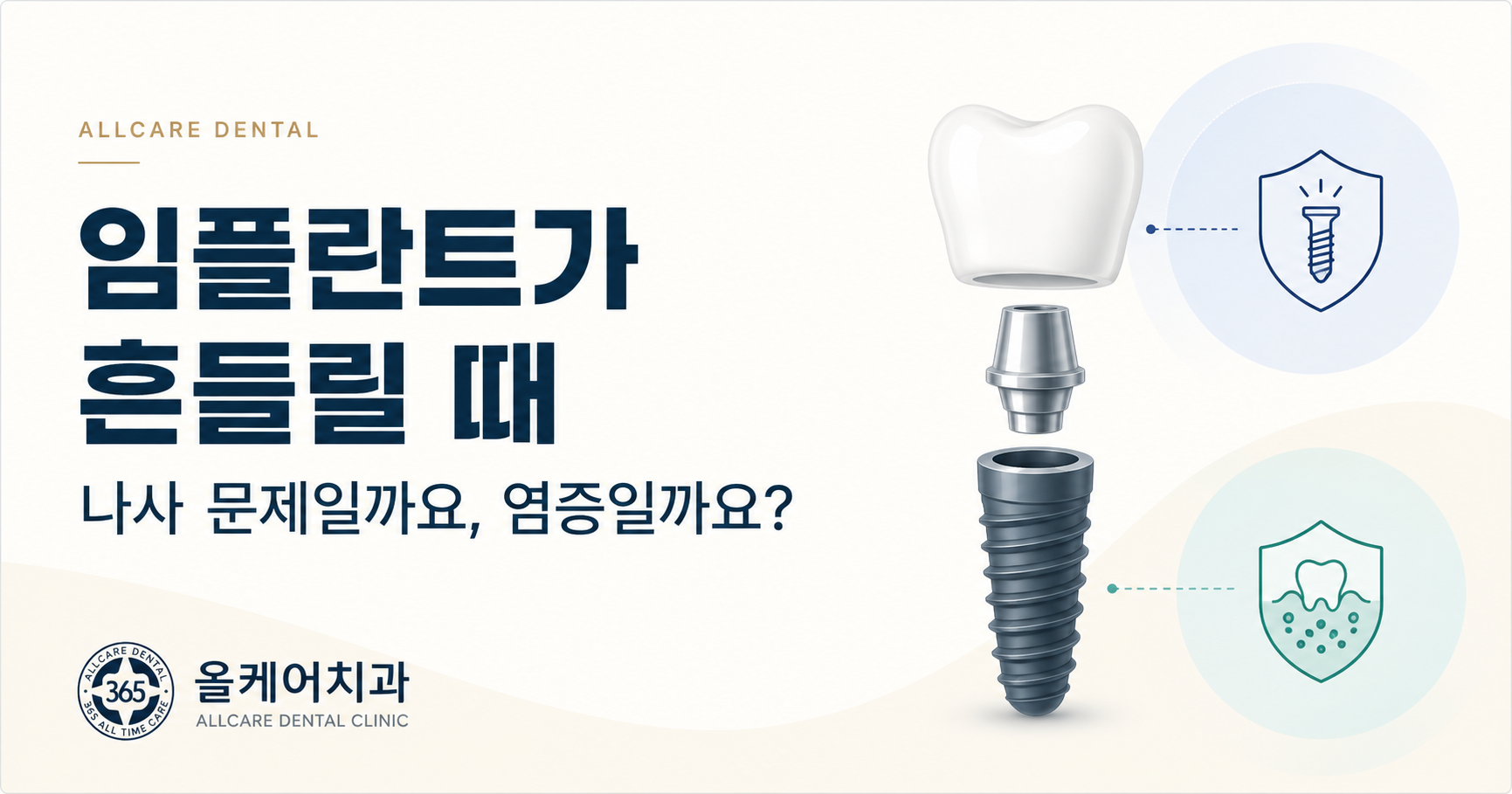 약수역 임플란트가 흔들리는 느낌, 나사 풀림과 염증은 어떻게 다를까요?