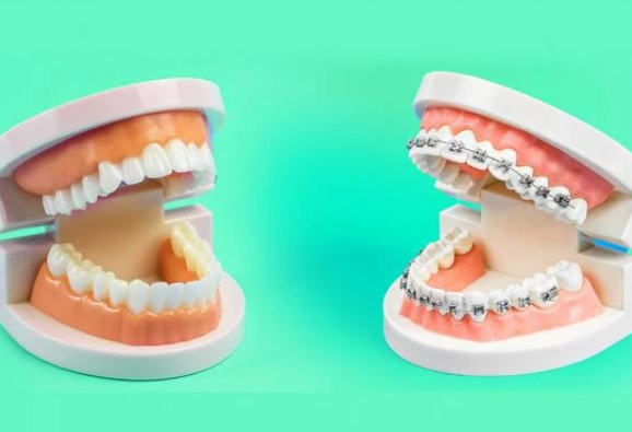 Clear Aligners vs Braces