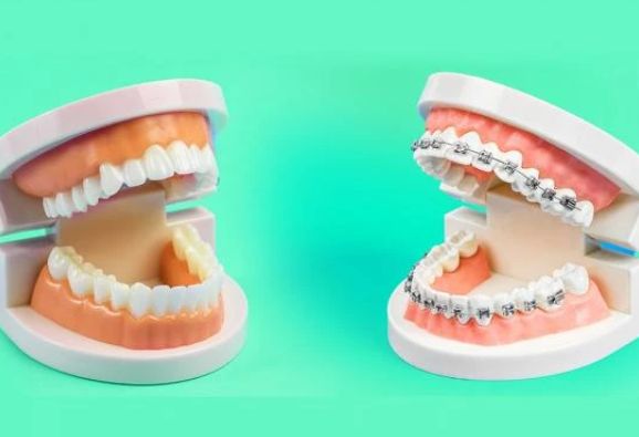 Clear Aligners vs Braces