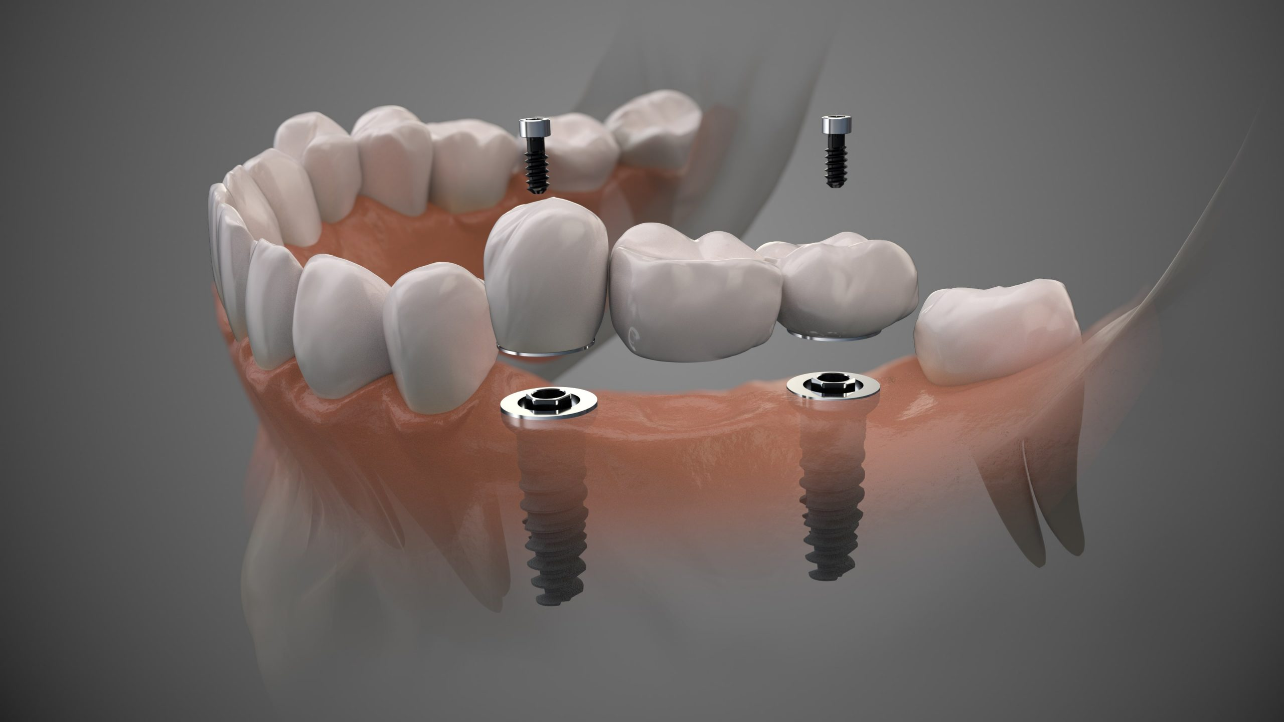 implant-aftercare