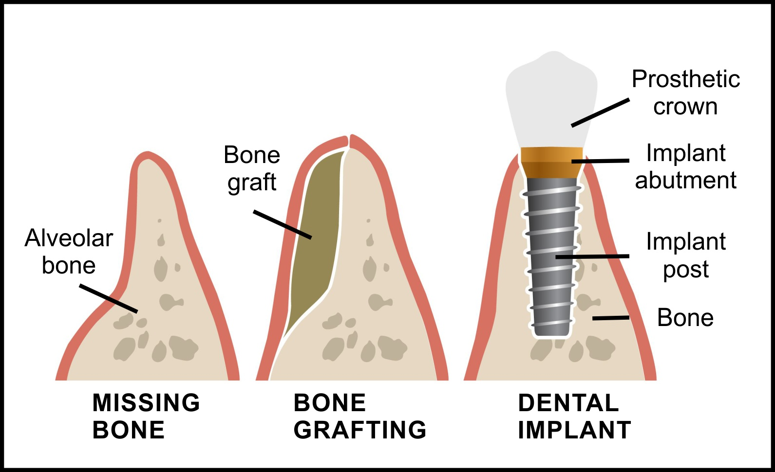 bone-graft-implant