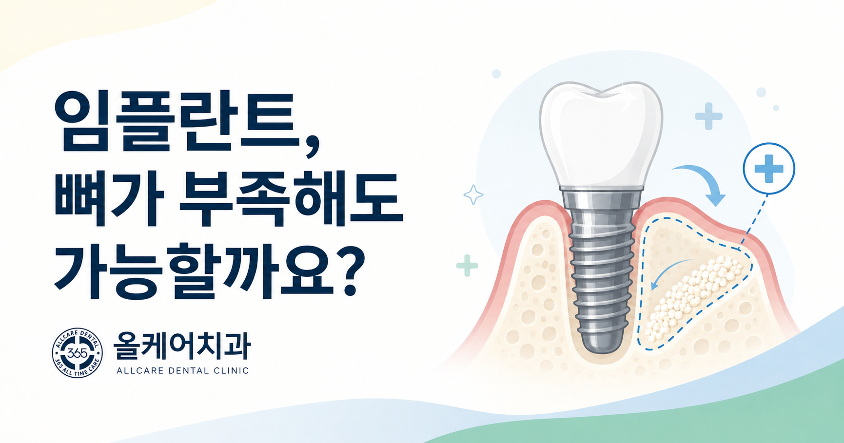 잇몸뼈가 부족한 부위에 골이식재를 채워 임플란트 식립 토대를 만드는 모습