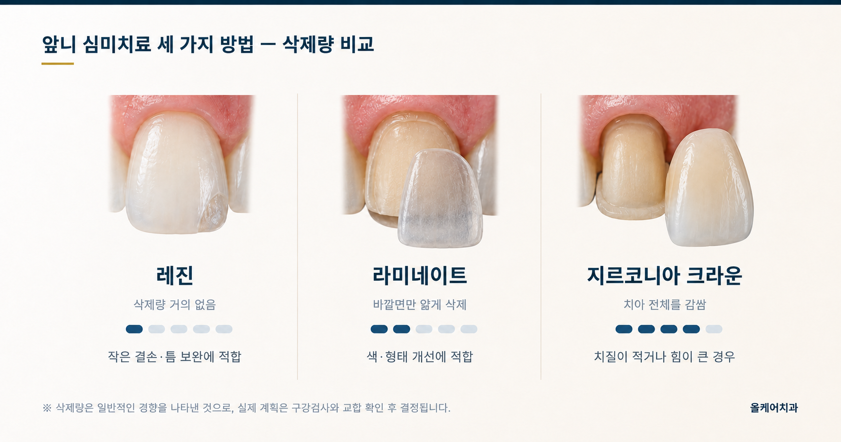 앞니 심미치료 세 가지 방법 - 삭제량 비교 도해