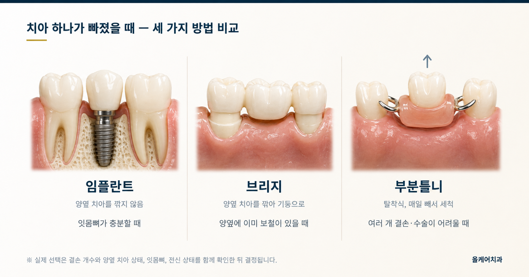 임플란트, 브릿지, 부분틀니로 빠진 치아 자리를 채우는 방식 비교 도해