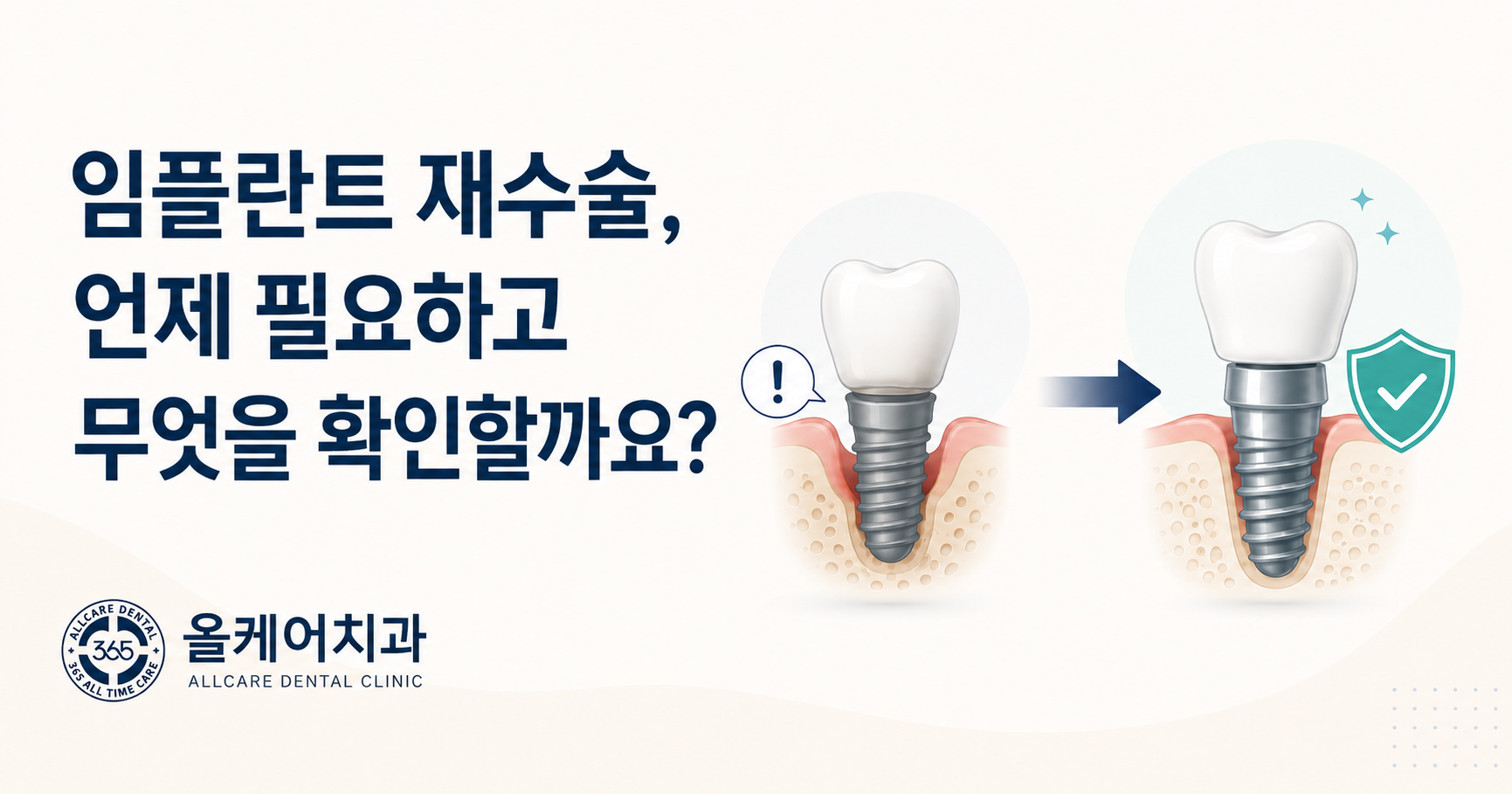 임플란트 재수술이 필요한 경우와 재수술 전 확인 사항을 정리한 안내 이미지