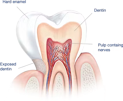 tooth-sensitivity-causes