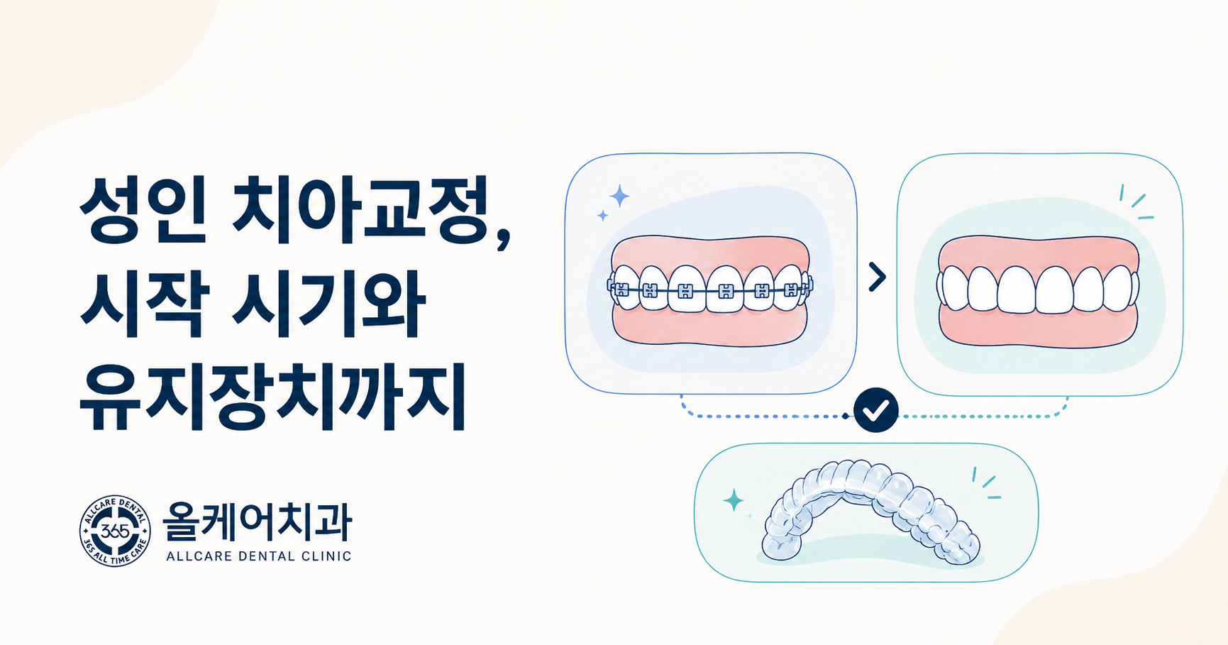 행당동 약수역 성인 치아교정, 시작 시기와 유지장치까지