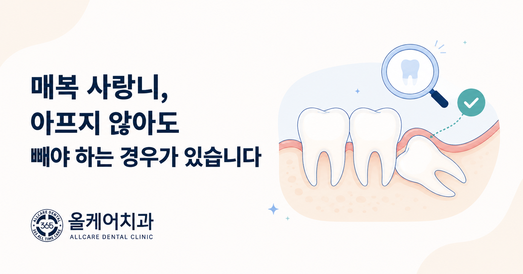 매복 사랑니를 빼야 하는 경우와 지켜봐도 되는 경우의 기준을 정리한 안내 이미지