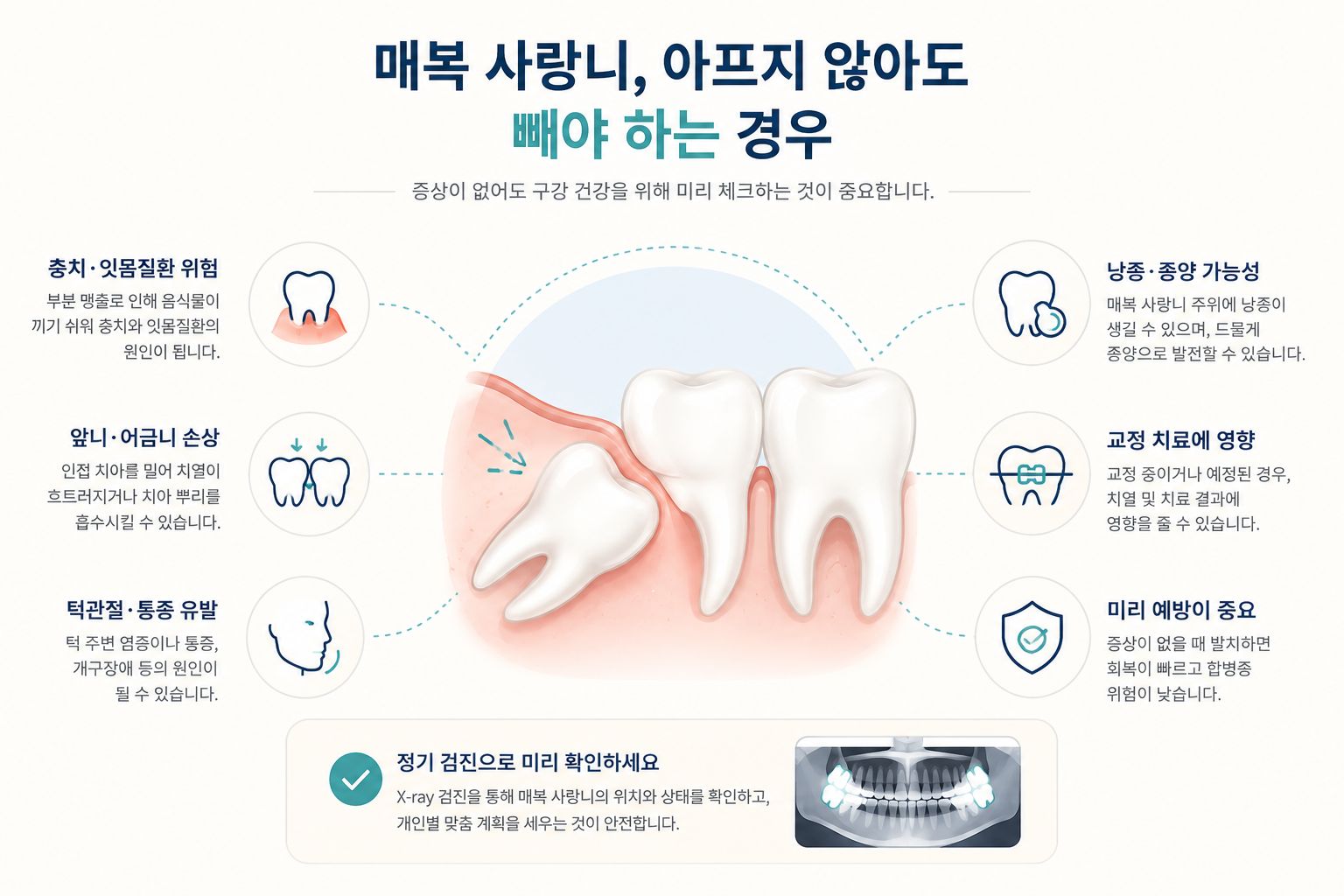 매복 사랑니, 아프지 않아도 빼야 하는 경우