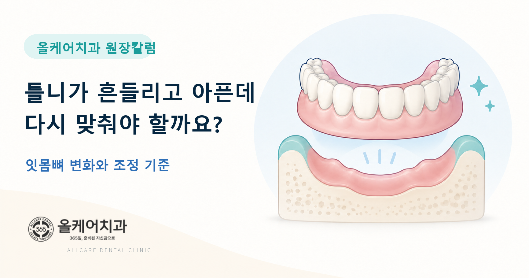 틀니 흔들림 원인과 조정 기준을 정리한 칼럼 대표 이미지