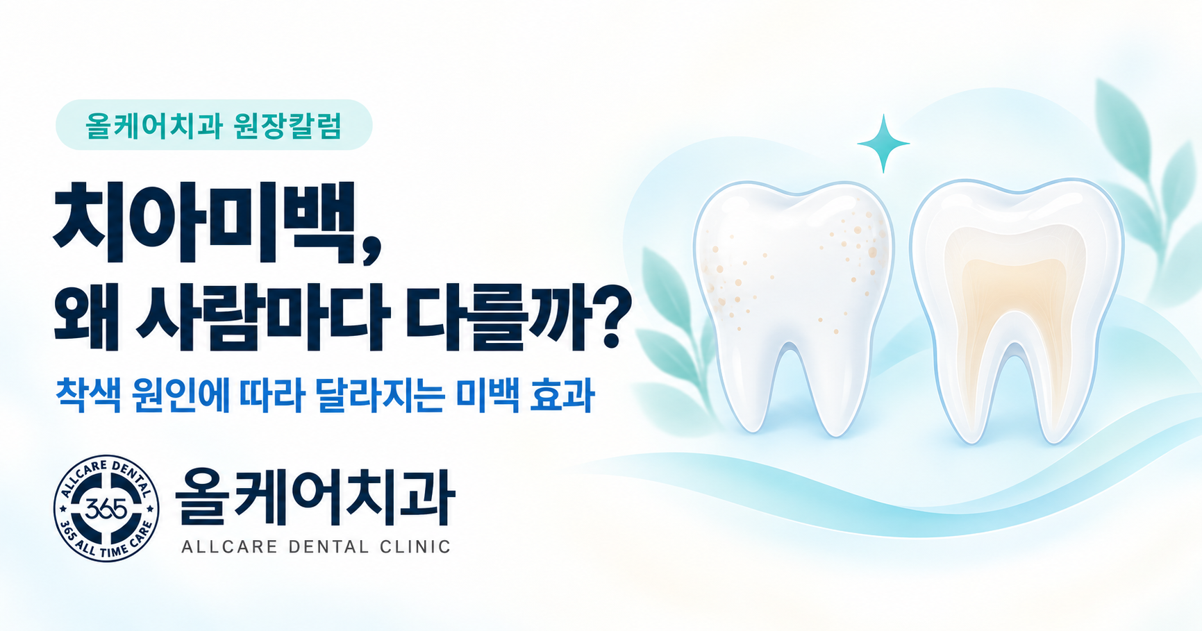 착색 원인에 따라 치아미백 효과가 달라지는 기준을 정리한 안내 이미지