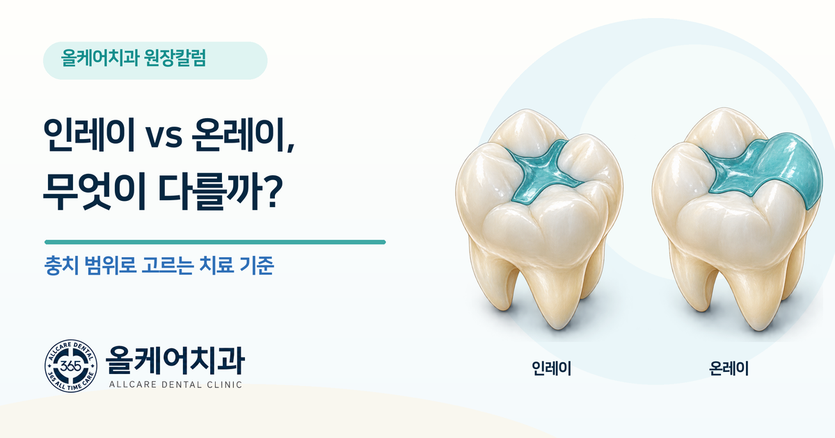 약수동 인레이 온레이, 무엇이 다른가요?