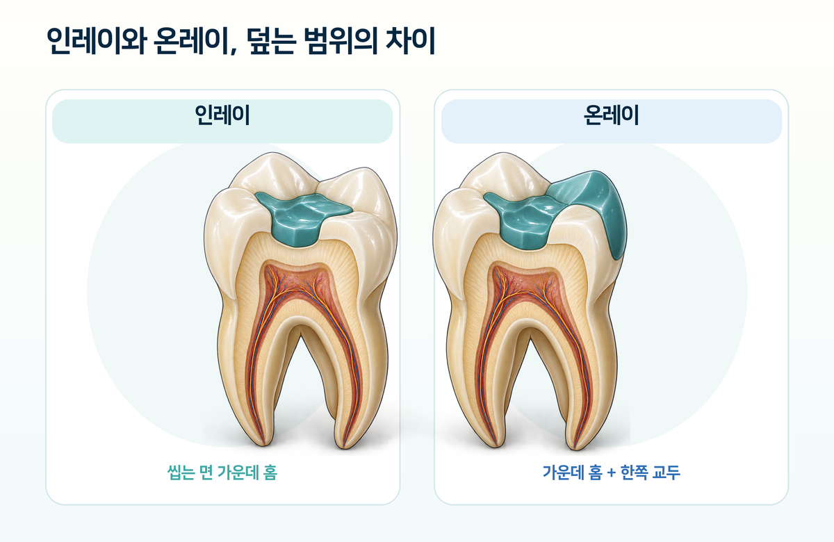 인레이와 온레이가 덮는 범위를 비교한 어금니 그림