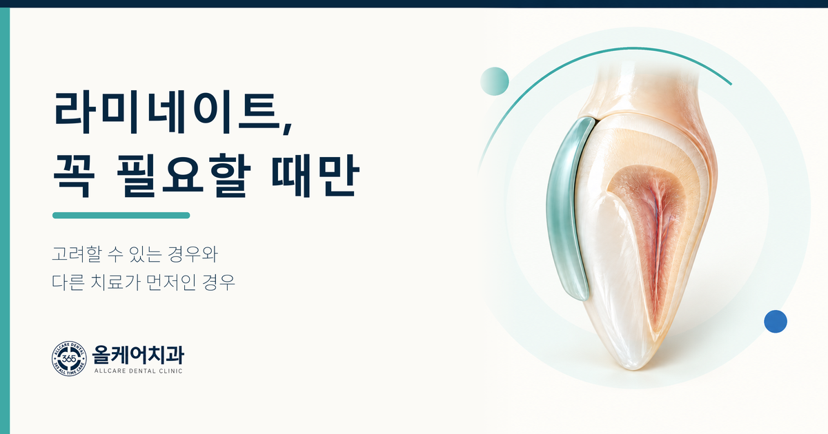 옥수동 라미네이트, 꼭 해야 하는 경우는 언제인가요?