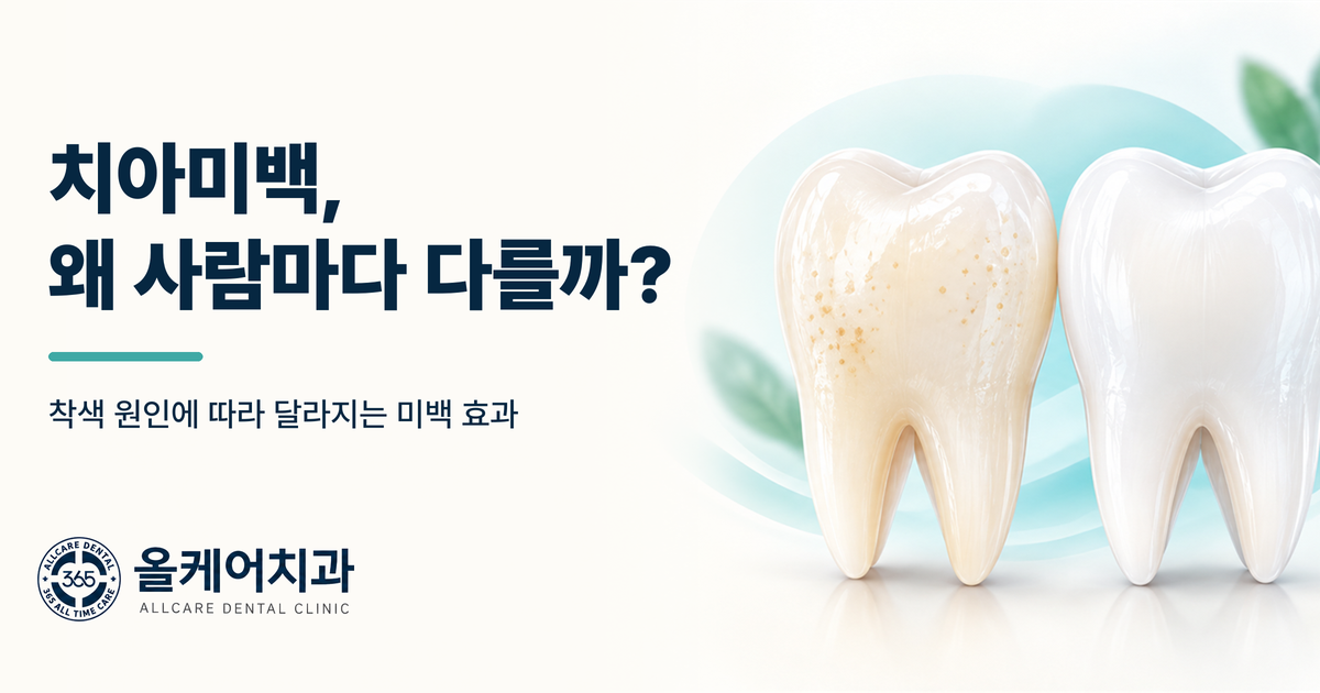 을지로 치아미백, 왜 사람마다 효과가 다른가요?