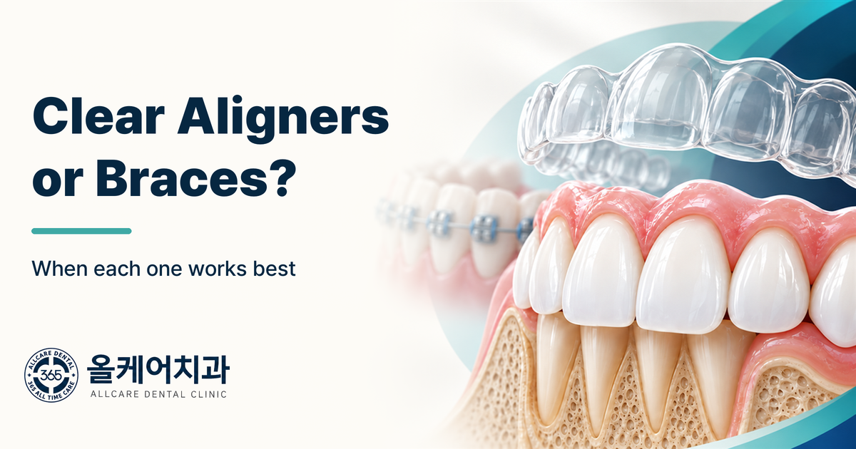 Clear aligners compared with braces