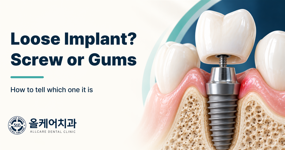 Why Does My Dental Implant Feel Loose? Screw Loosening vs. Inflammation
