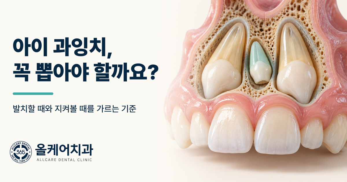 아이 과잉치 발치가 꼭 필요한지 판단 기준을 정리한 칼럼 이미지