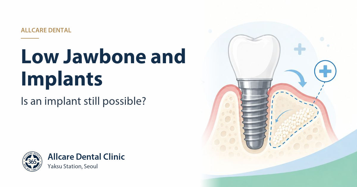 Can I Get Dental Implants If I Don't Have Enough Jawbone?