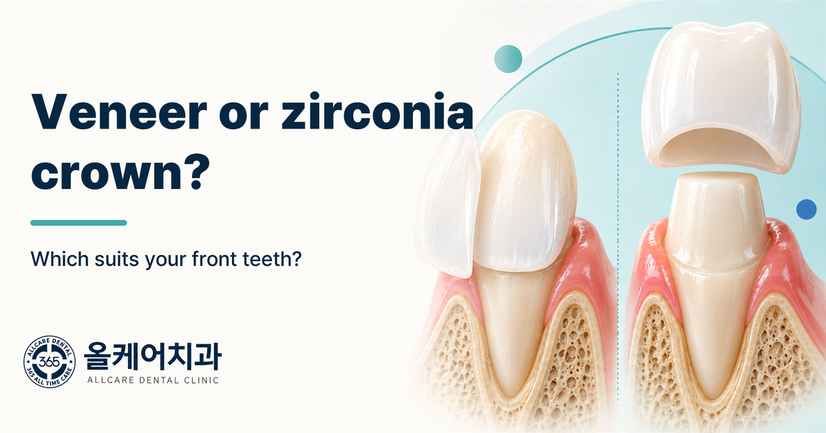 Front tooth veneer and zirconia crown