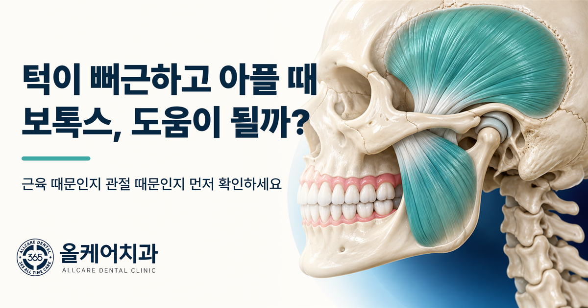 턱 근육 긴장과 보톡스의 작용을 표현한 올케어치과 칼럼 대표 이미지