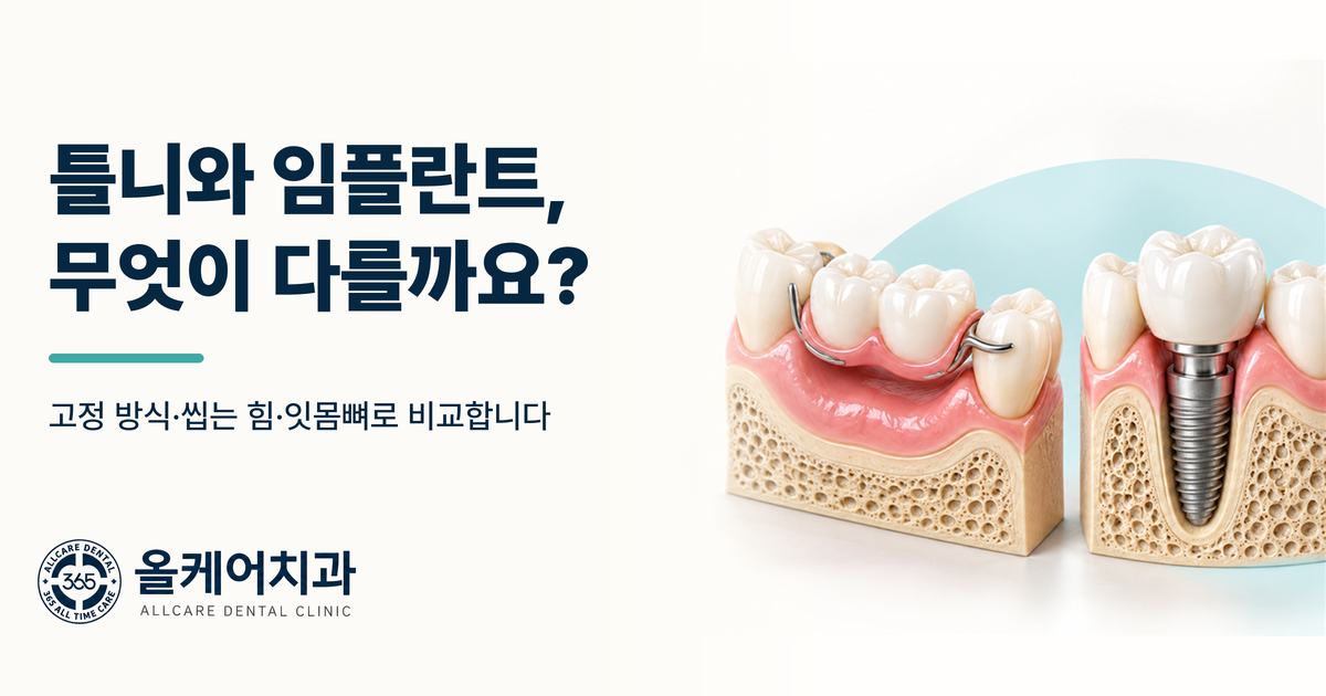 틀니와 임플란트의 차이를 비교한 올케어치과 원장칼럼 대표 이미지